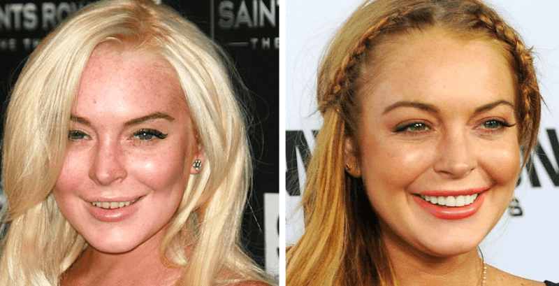 15 Celebrities Who Had To Go Through Cosmetic Dentistry & Now Have New Teeth
