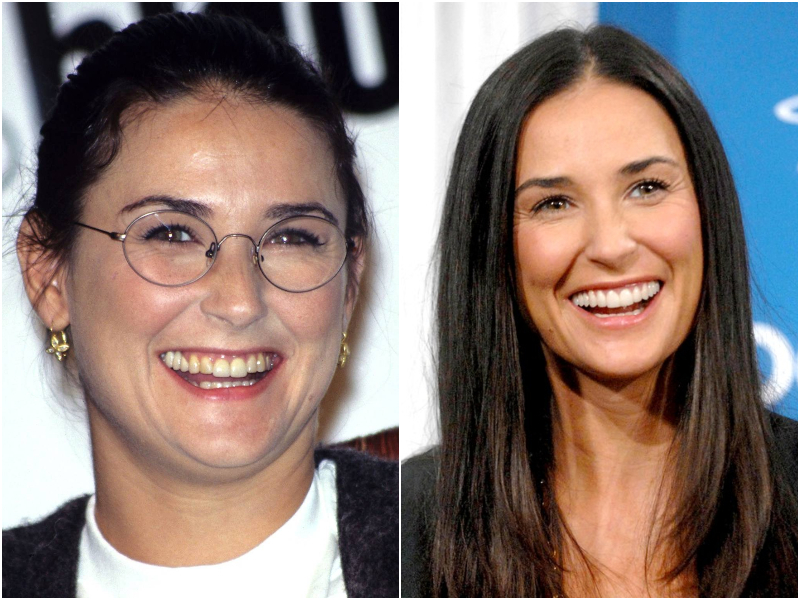 15 Celebrities Who Had To Go Through Cosmetic Dentistry & Now Have New Teeth