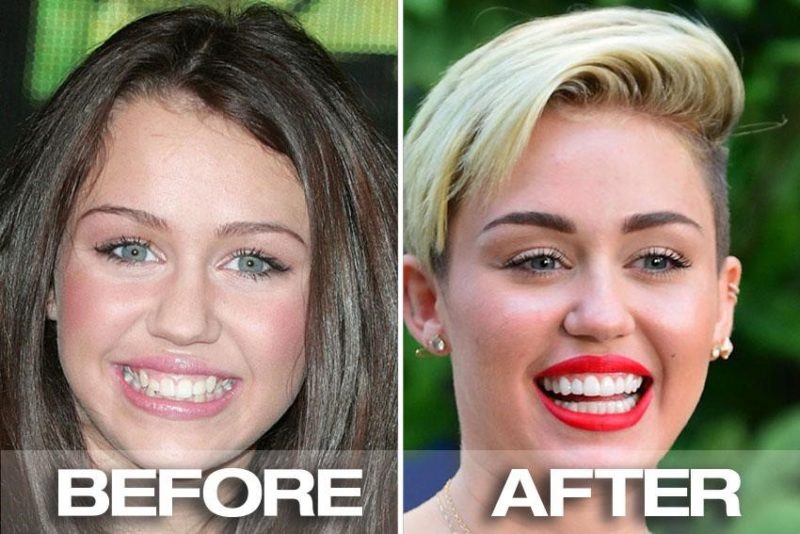 15 Celebrities Who Had To Go Through Cosmetic Dentistry & Now Have New Teeth