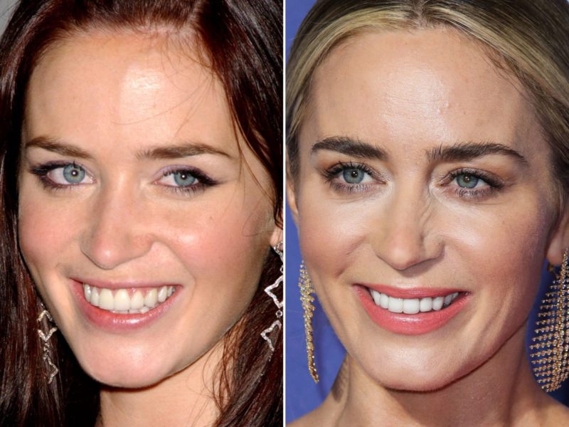 15 Celebrities Who Had To Go Through Cosmetic Dentistry & Now Have New Teeth