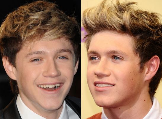 15 Celebrities Who Had To Go Through Cosmetic Dentistry & Now Have New Teeth