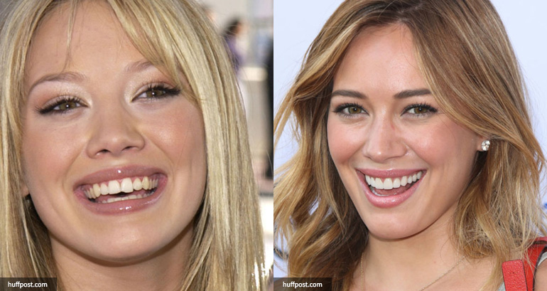 15 Celebrities Who Had To Go Through Cosmetic Dentistry & Now Have New Teeth